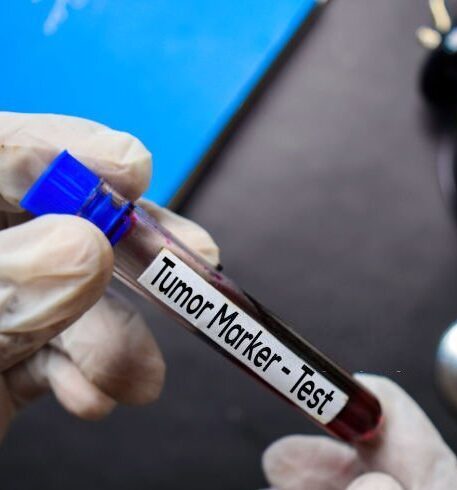 Tumor markeri